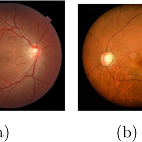 A Shows A Fundus Image Of A Normal Eye While B Shows The Fundus