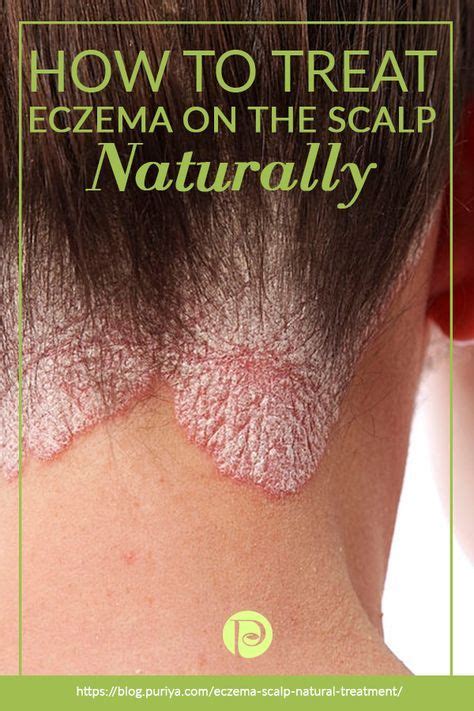 Natural scalp treatment acne 5 Natural