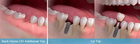 Immediate Loaded Dental Implants And Implants Procedure