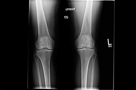 Case Study Bilateral Knee Pain Due To Osteoarthritis Clinical Pain