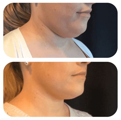 Cosmetic Treatments That Can Help With Double Chins