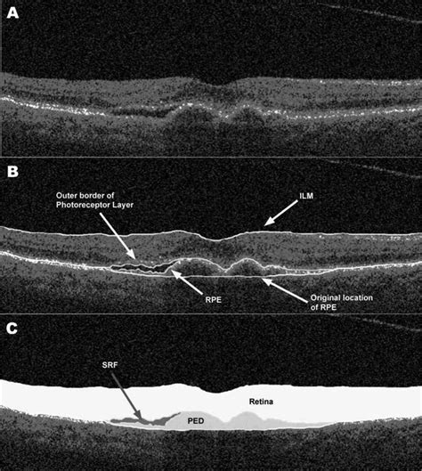 Relationship Between Optical Coherence Tomography Retinal Parameters