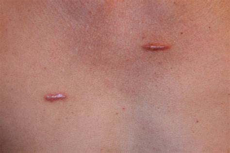 Keloid Scar Treatment Is It A Lost Cause Skinpractice