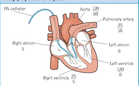 A Practical Guide To Using Pulmonary Artery Catheters Semantic Scholar
