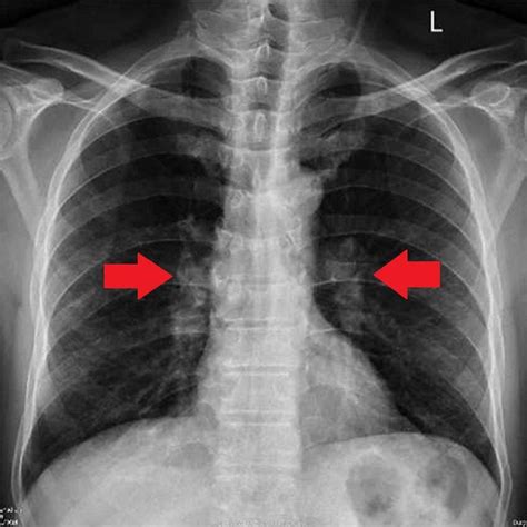 Chest X Ray Before Treatment With Doxycycline With Presence Of