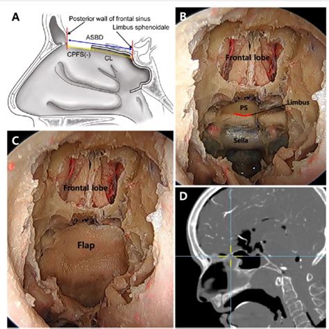 Anterior Skull Base Reconstruction With Sphenoidotomy A An