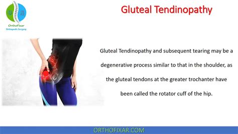 Gluteal Tendinopathy Easy Explained Orthofixar