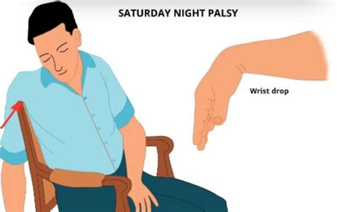 Saturday Night Palsy A Case Discussion International Emergency