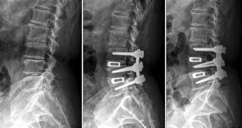 Typical Instrumented Lumbar Interbody Fusion L3 4 And L4 5 A