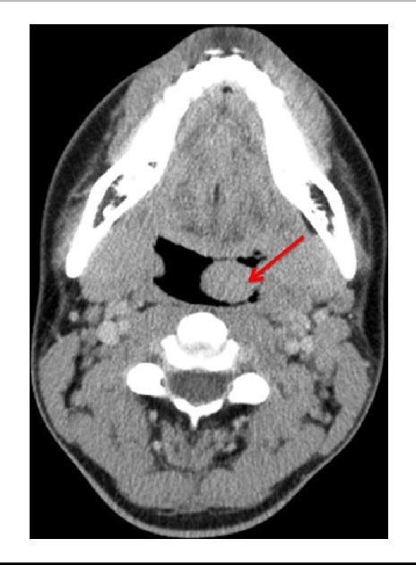 Figure 1 From Spindle Cell Mucoepidermoid Carcinoma Of The Palatine