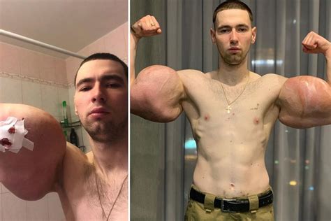 Russian Bodybuilder With 24 Inch Oil Injected Popeye Biceps Has Surgery To Save Arms After