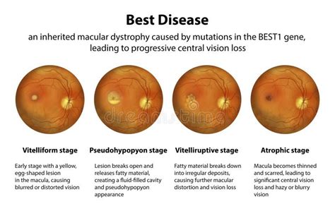 Stages Of Best Vitelliform Macular Dystrophy Illustration Stock
