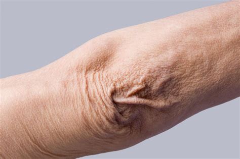 How To Get Rid Of Crepey Skin On Upper Arms Emerald Spa
