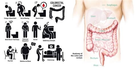 To catch it early, learn the symptoms of lung cancer. A change in colon cancer screening recommendations, from ...
