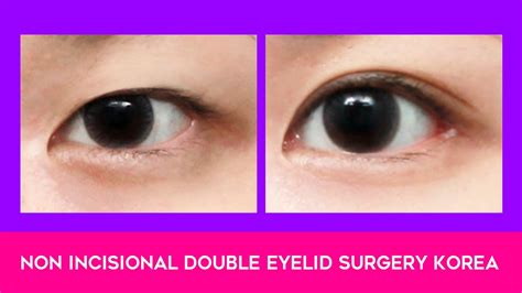 Non Incisional Double Eyelid Surgery Korea Youtube