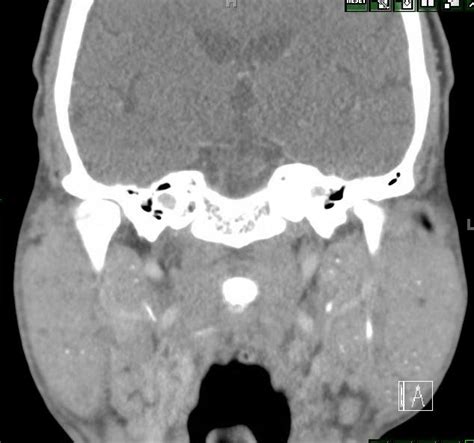 A 70 Yo Man Presents With A One Day History Of Bilateral Parotid
