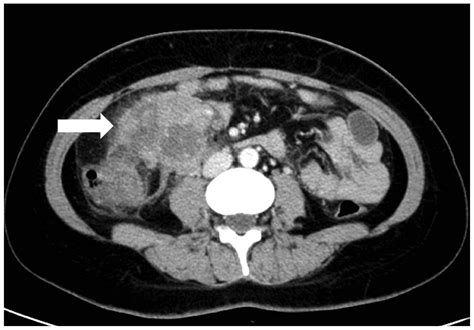 Non Hodgkins Lymphoma With Uncommon Clinical Manifestations A Case Report