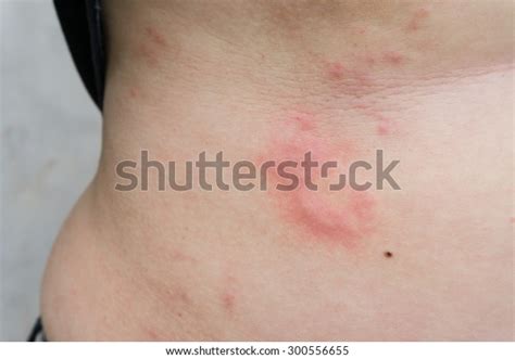 Woman Urticaria On Belly Stock Photo 300556655 Shutterstock