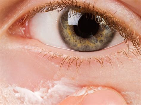 Safe Periocular Steroid Use For Eyelid Dermatitis Clinical Advisor