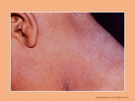 Dermatoses Of Childhood 7 Photoclinic Cases