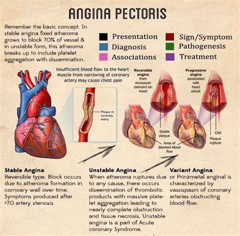 What Is Angina Learn The Symptoms Risk Factors Causes And Treatment