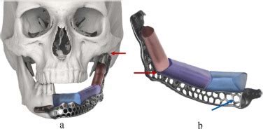 Prosthetically Guided Mandibular Reconstruction Using A Fibula Free