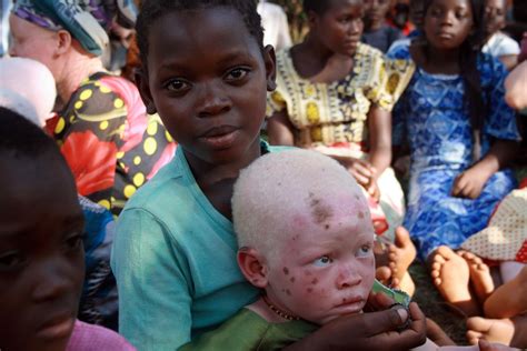 Tanzania Bans Witch Doctors To Curb Albino Killings But Ghost