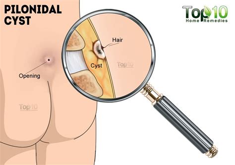 Home Remedies For Pilonidal Cysts Large Pimple At Bottom