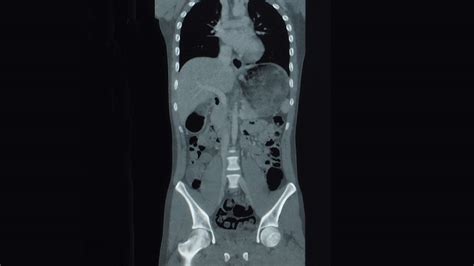 Normal Ct Scan Abdomen