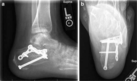 A Lateral Calcaneal View 10 Weeks After Sinus Tarsi Approach With