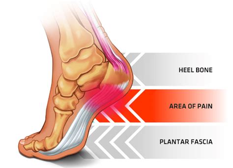 Plantar Fasciitis The Most Common Cause Of Heel Pain Podiatry First