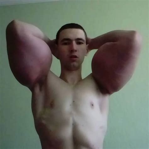 Qué es el Synthol la sustancia que se inyectó Popeye en el cuerpo y por la que puso en