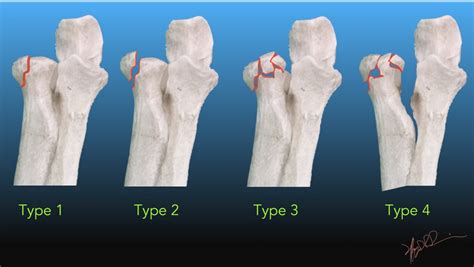 Mason Johnston Classification Of Radial Head Fractures Uw Emergency Radiology