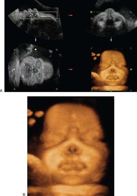The Role Of Three Dimensional Ultrasound In The Evaluation Of The Fetus