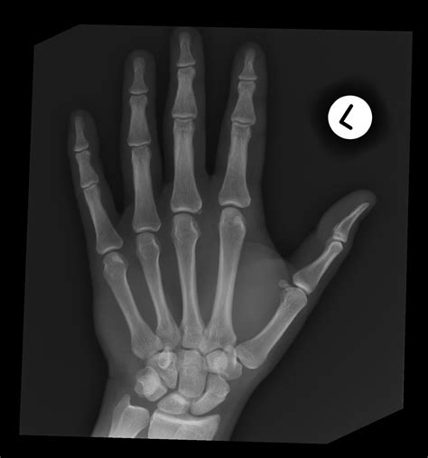 Old Avulsion Fracture At Metacarpophalangeal Joint Image