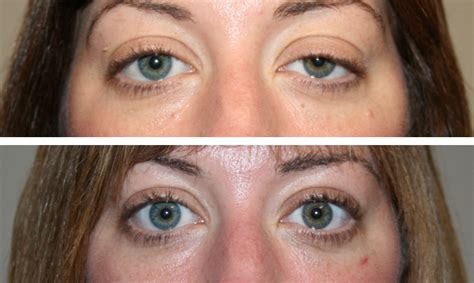 Ptosis Eyelid Surgery Centre Eyelid And Midface Specialist Surgeon