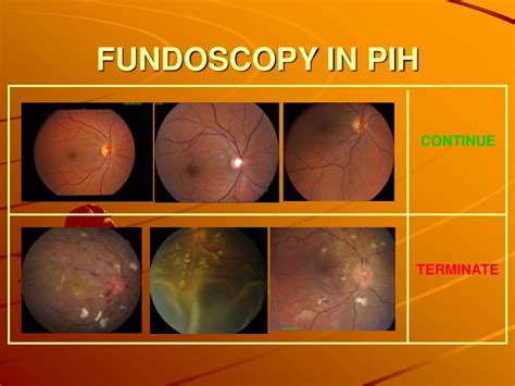Ppt Fundoscopy In Pih Powerpoint Presentation Free Download Id246458