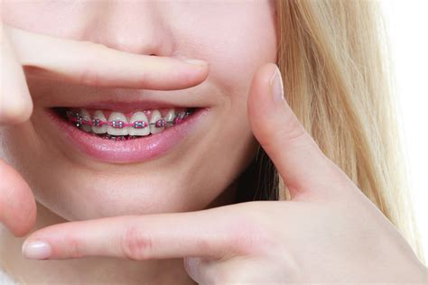 Dental Myths About Dental Braces