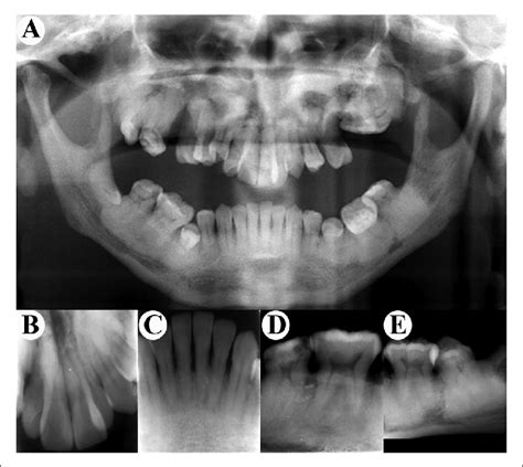 No significant associations were found between the type of fracture and the presence of. Radiologic findings of teeth. (A) Orthopantomography ...