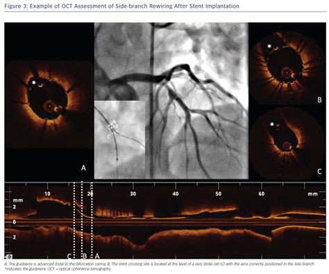 Example Of Oct Assessment Of Side Branch Rewiring After Stent