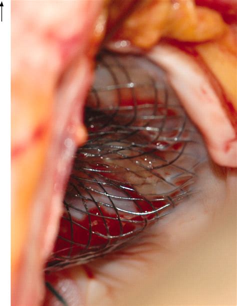 Failed Endothelialisation Of A Percutaneous Atrial Septal Defect