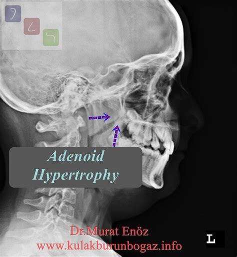 Adenoidectomy Operation In Istanbul