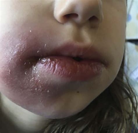 Persistent Facial Swelling In An 8 Year Old The Journal Of Pediatrics