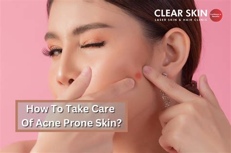 How To Take Care Of Acne Prone Skin