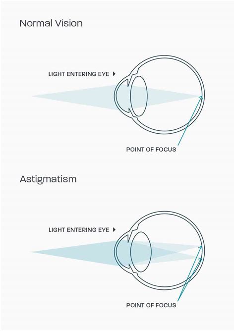 Astigmatism Glasses Direct