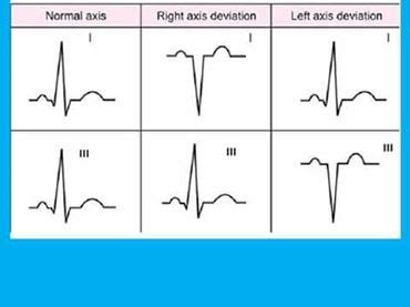 In the vast majority of cases, this is the. Study Medical Photos: Understanding Axis Deviation On ECG
