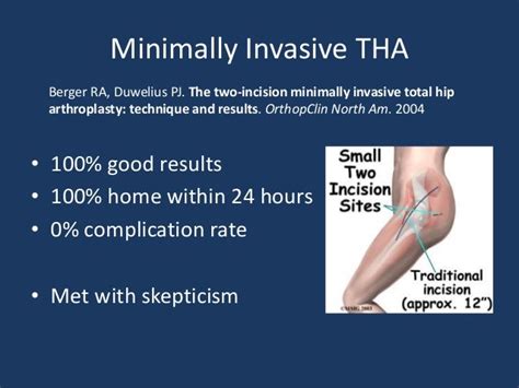 Community Minimally Invasive Total Hip Replacement Slideshow
