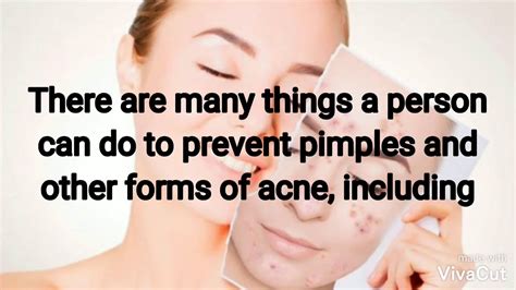 15 Ways To Prevent Pimples Acne Prevention YouTube