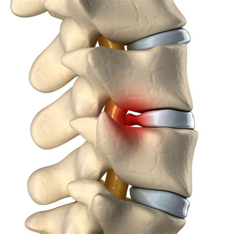 Causes And Treatments Of Lumbar Herniated Discs And The Brain Spine
