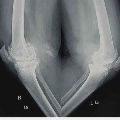 Lateral View Radiograph Of The Bilateral Knee Joint With Severe